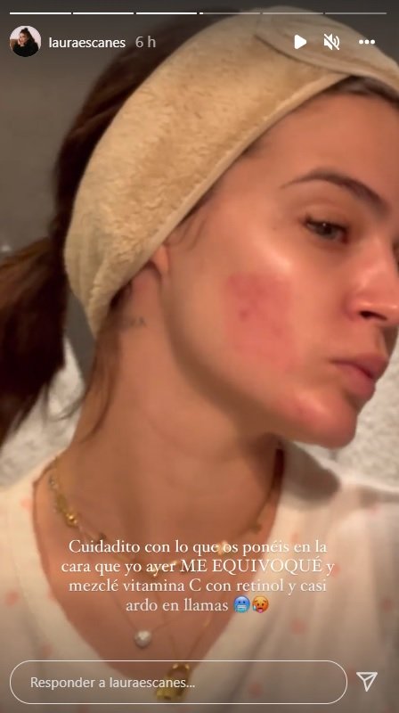 laura escanes cara cremada 2