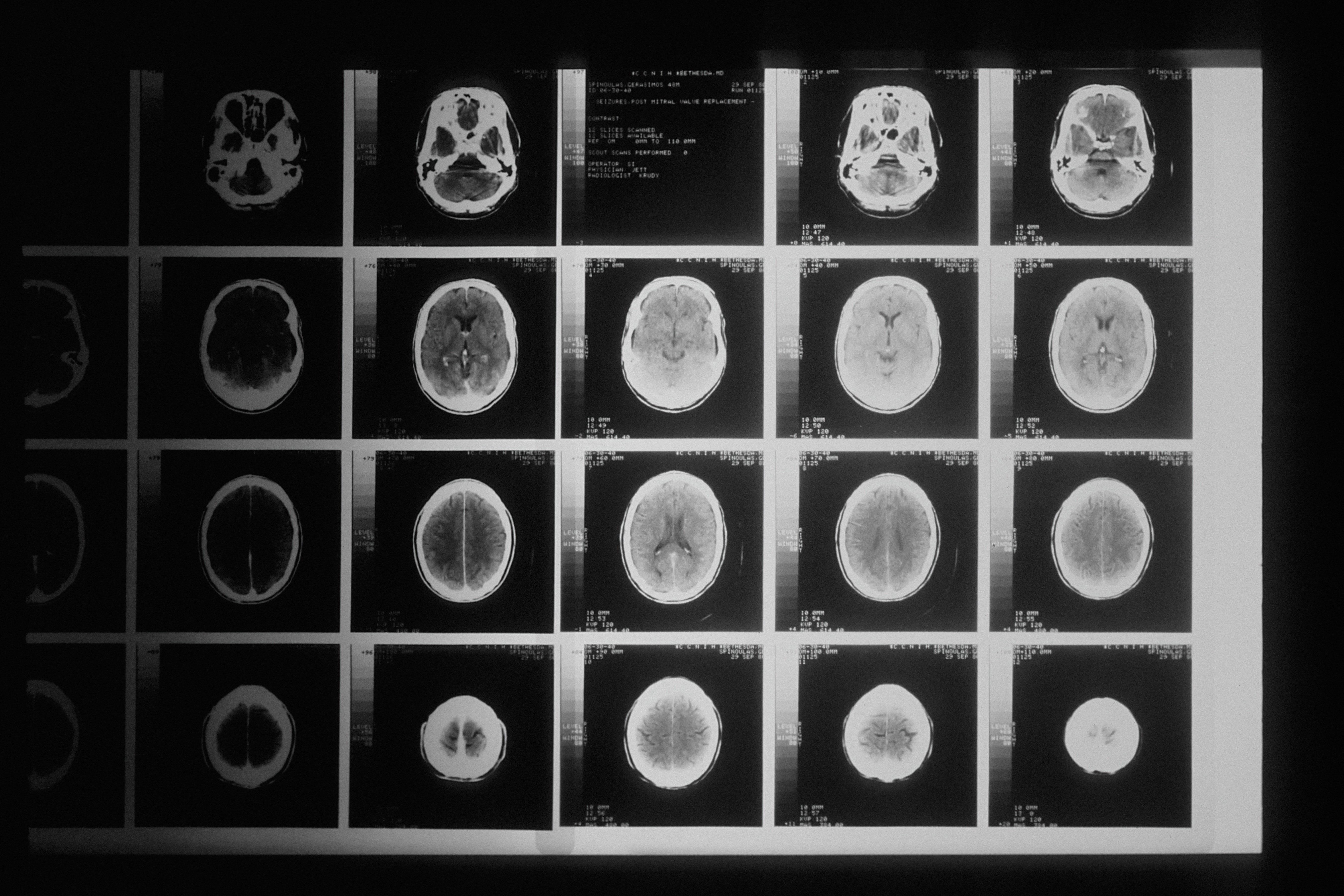 Un estudio del Clínic hace avanzar hacia la recuperación total del ictus