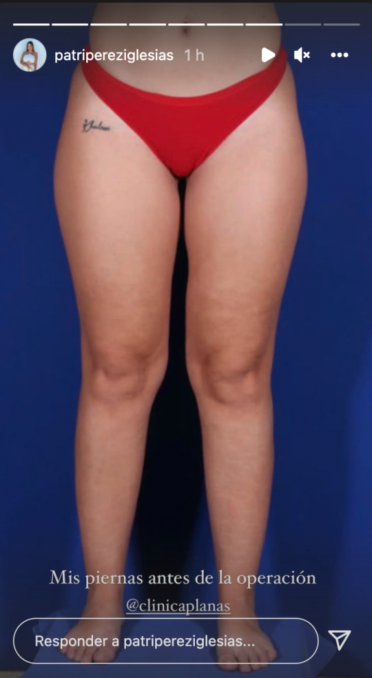 Patri lipedema