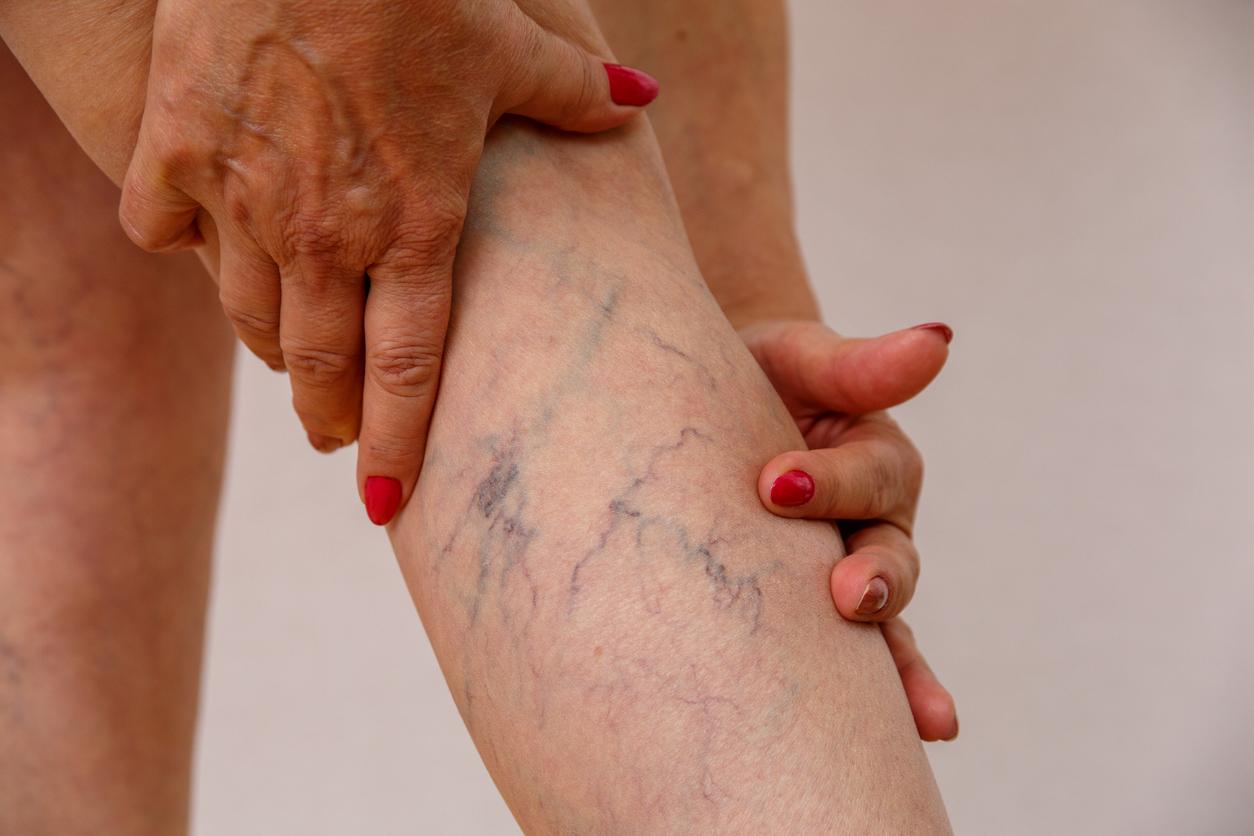 Arañas vasculares: qué son y cómo evitarlas para este verano