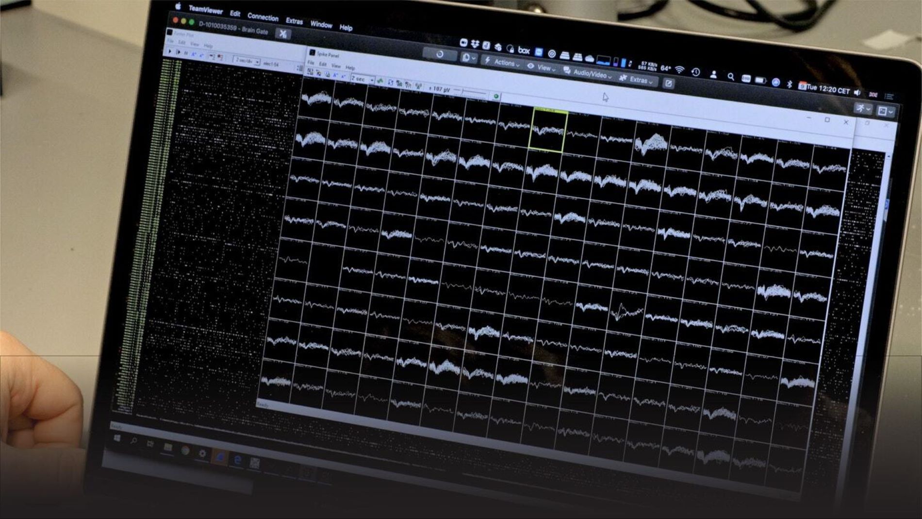 Un hombre con ELA y parálisis total vuelve a hablar por a un chip en el cerebro