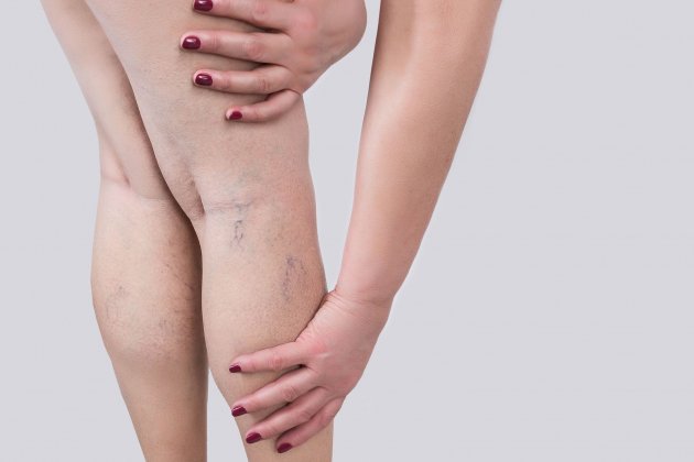 varices