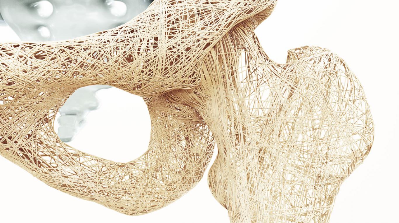 Osteoporosis: esto es lo que debes saber para combatirla y cómo se diagnostica