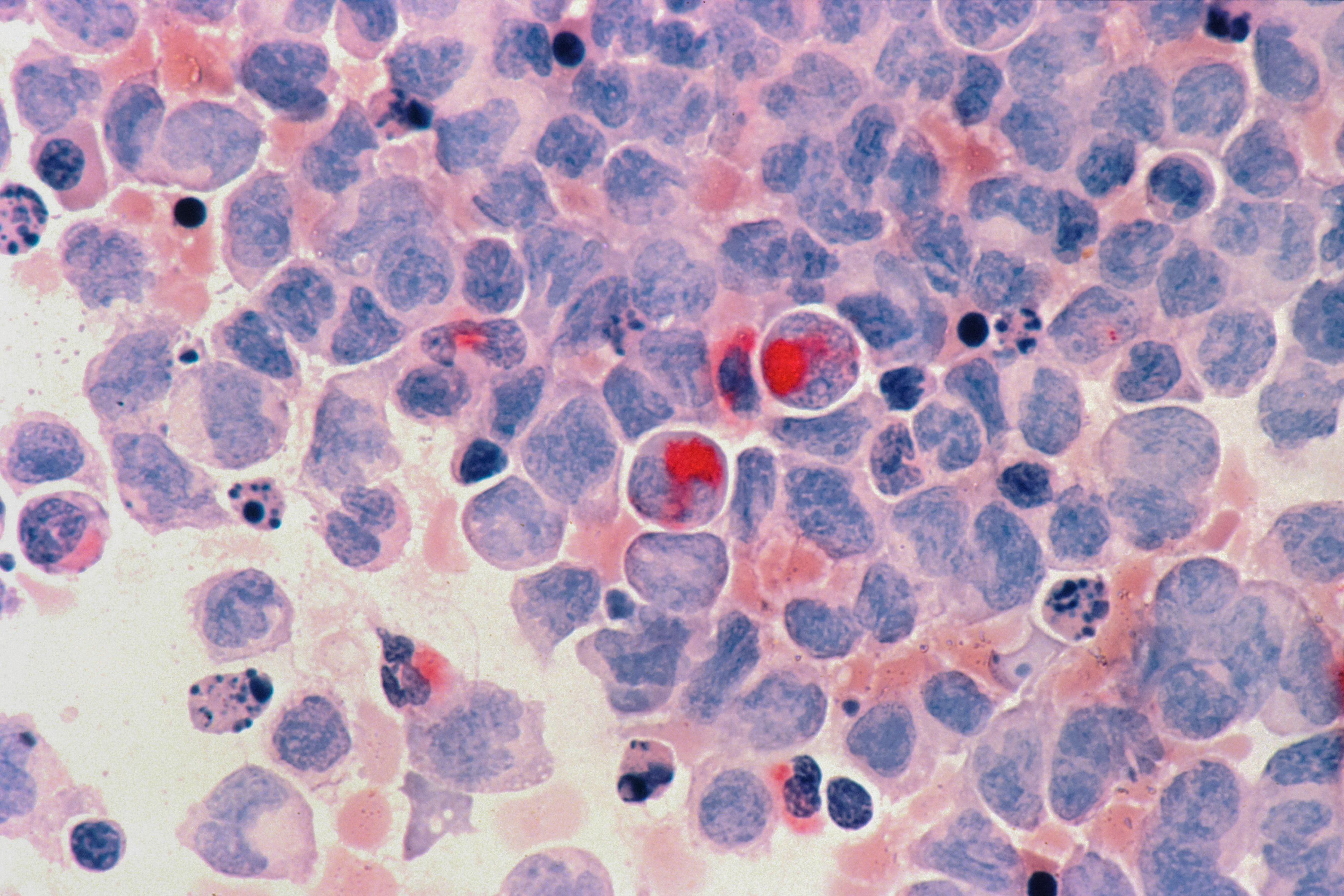 Imagen de leucemia mieloide aguda