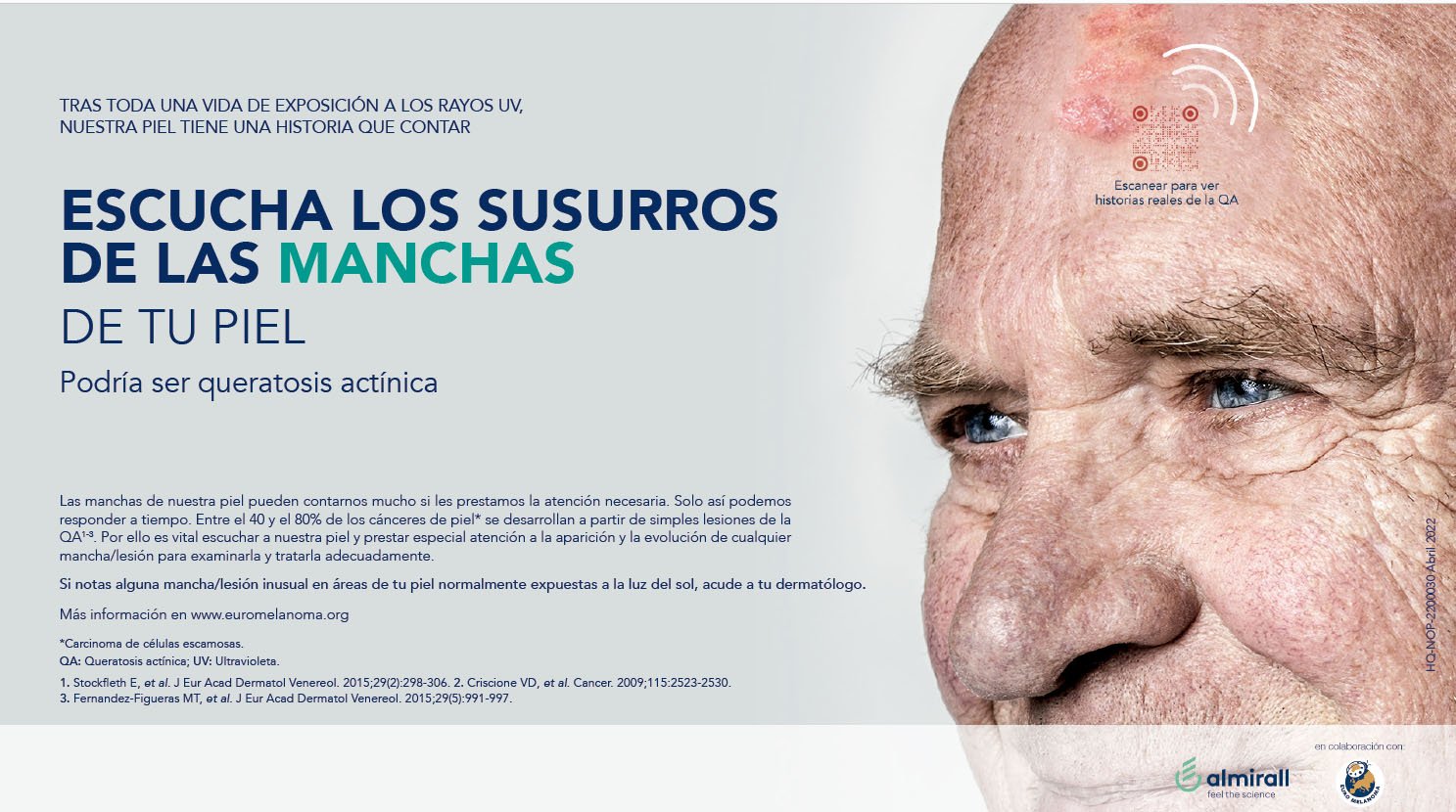 Queratosis actínica