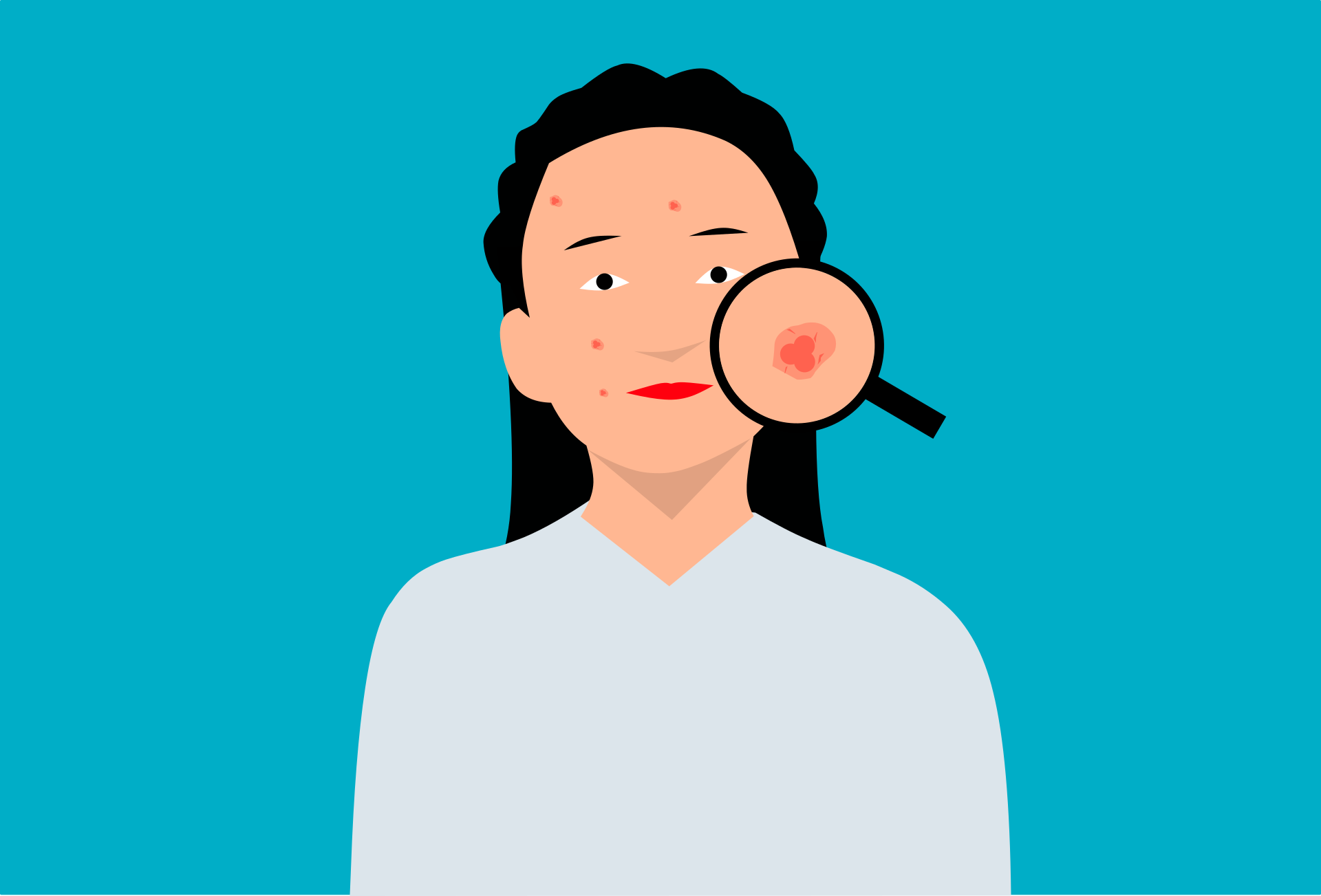Ilustración de una jovén con acné : Pixabay Ilustración de una jovén con acné : Pixabay