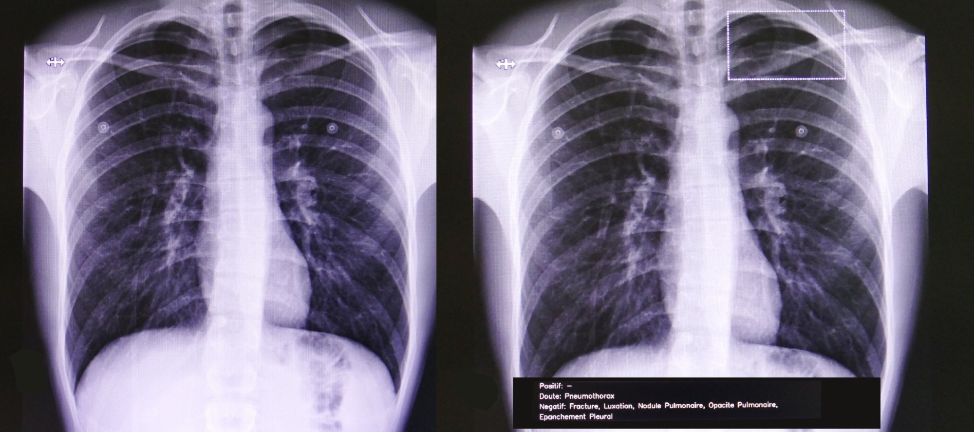 Nueva estrategia contra el cáncer de pulmón: combinación de quimioterapia e inmunoterapia