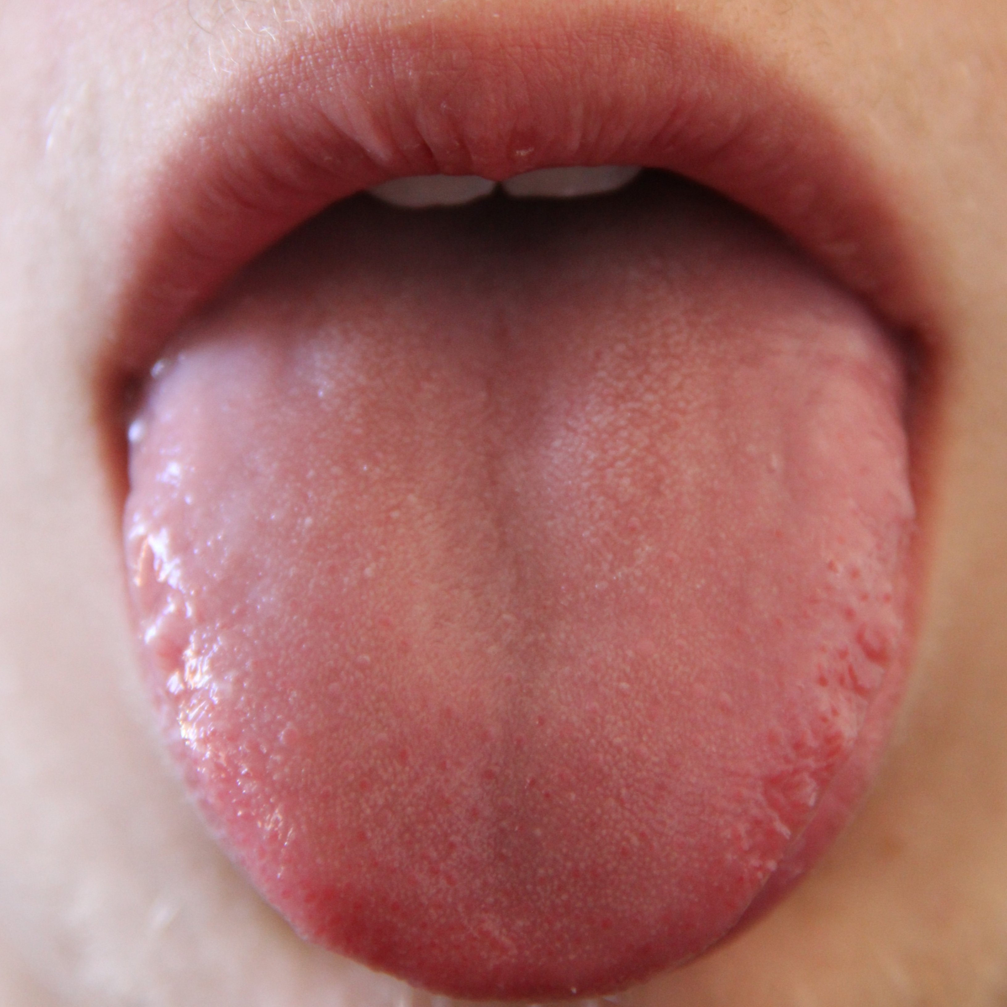 Cuáles pueden ser las causas de una lengua hinchada