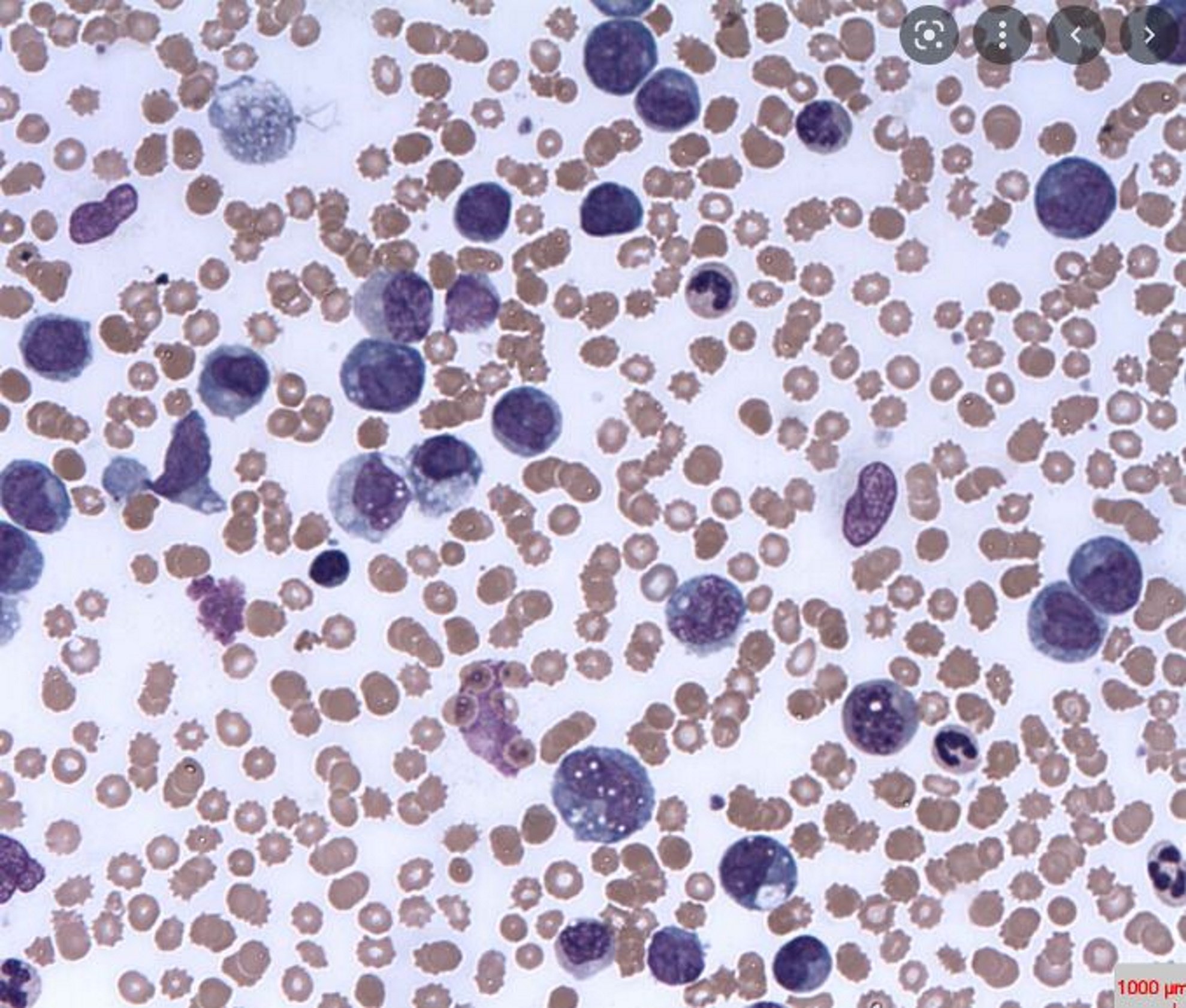 Un equip catalano-israelià troba un gran avenç per a la leucèmia