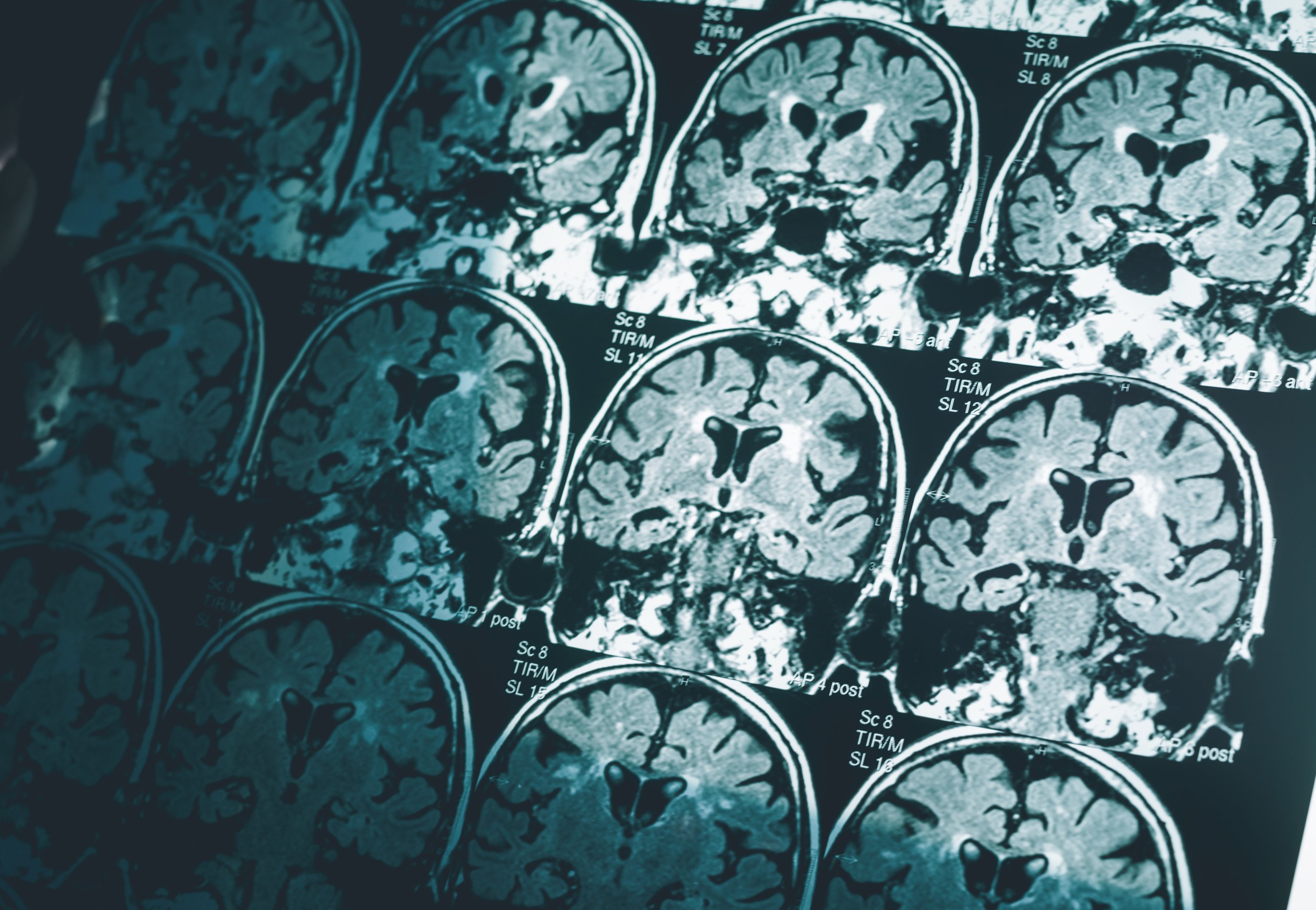 Un fármaco experimental reduce el deterioro cognitivo en personas con Alzheimer