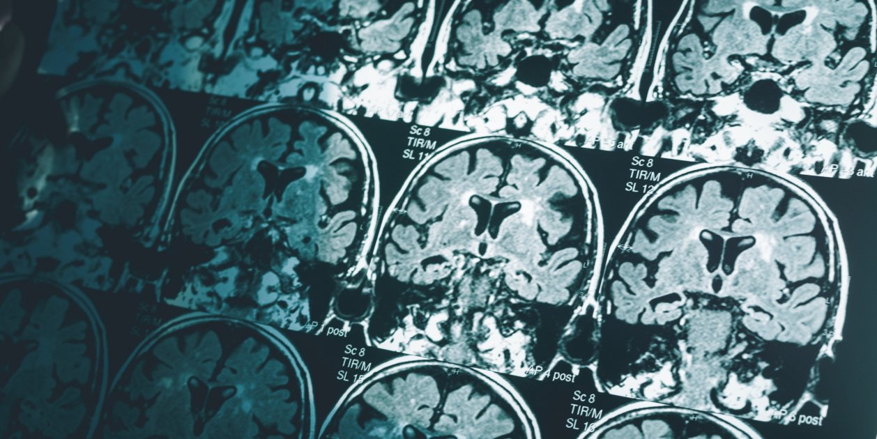 Escáner de cerebro, Alzheimer   Imperial College London