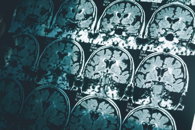 Escàner de cervell, Alzheimer Imperial College London