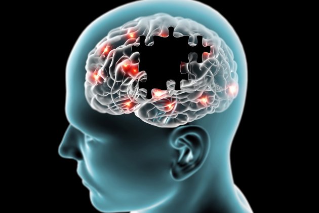 Alzheimer Alzheimer