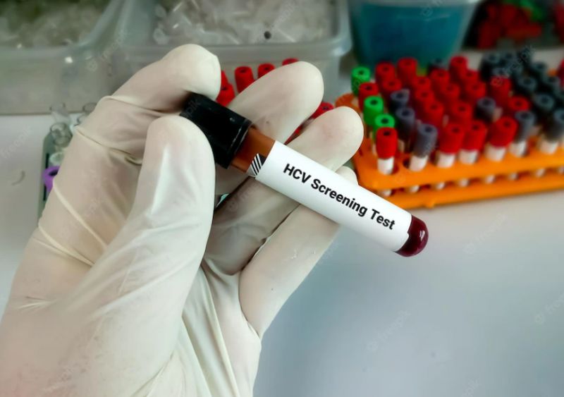 Expertos destacan las estrategias de cribado oportunista para facilitar la eliminación de la hepatitits C