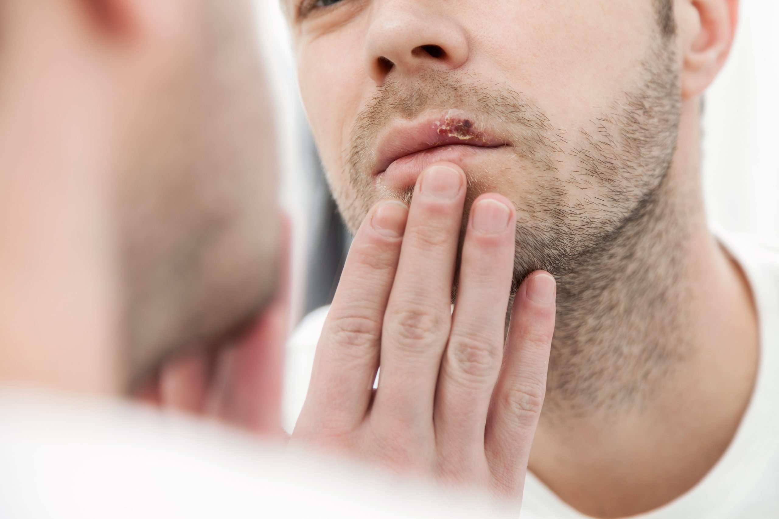 Esto debes saber del herpes y de cómo lo podemos prevenir