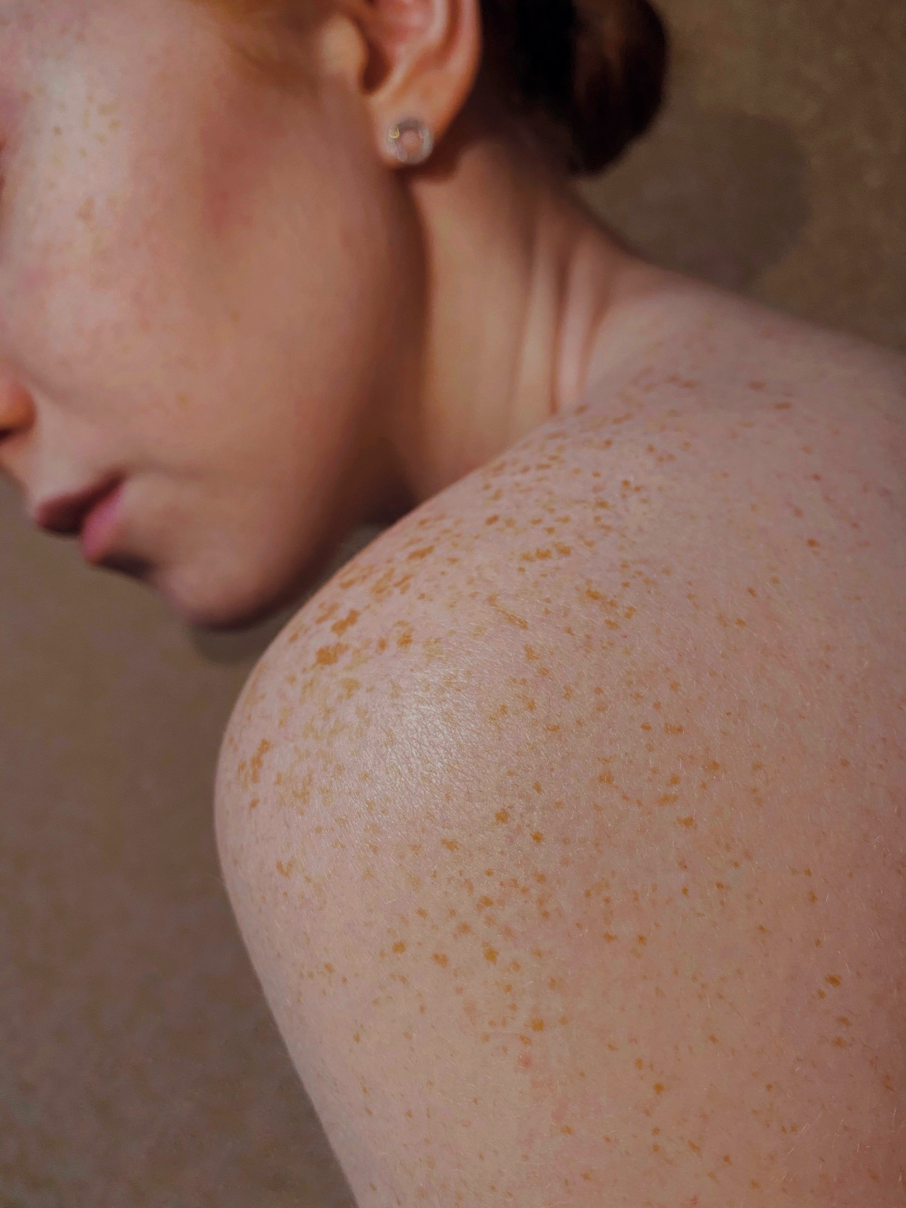 Prevención y tratamientos para evitar las manchas en la piel por el sol