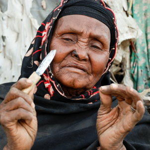 Mutilació genital Mutilació genital