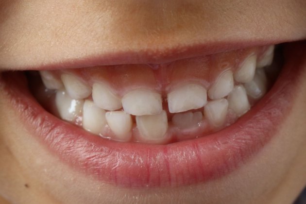 Imatge de les dents d'un infant / Foto: Josef Pichler