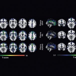 EE.UU. aprueba un medicamento que reduce el deterioro cognitivo en personas con Alzhéimer