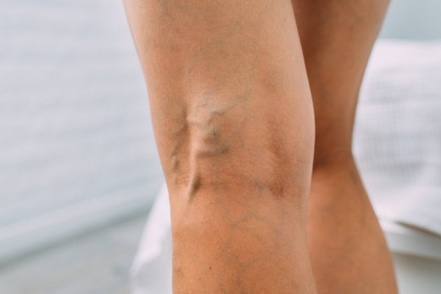 Varices Varices