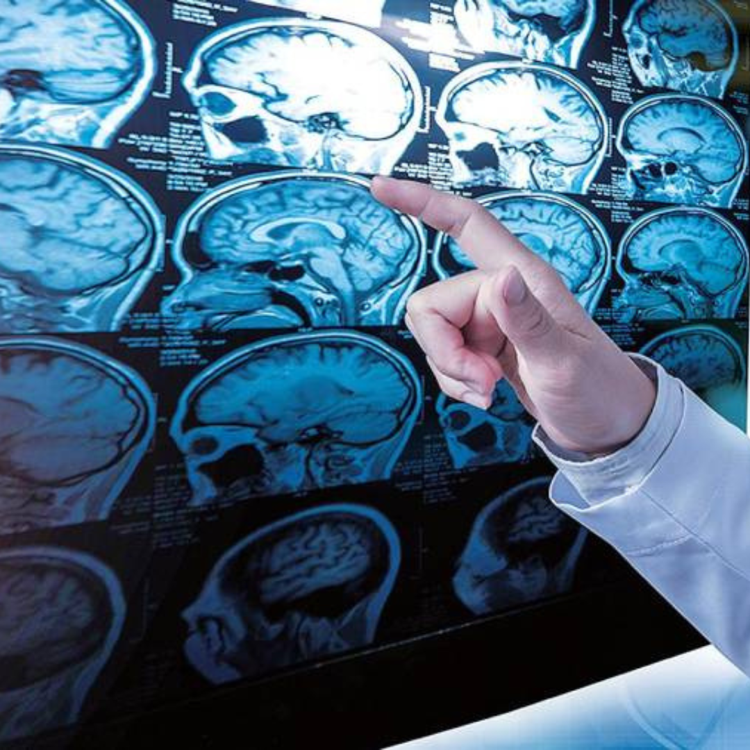 Neurólogos abogan por abordar la Esclerosis Múltiple de inicio con tratamientos de alta eficacia