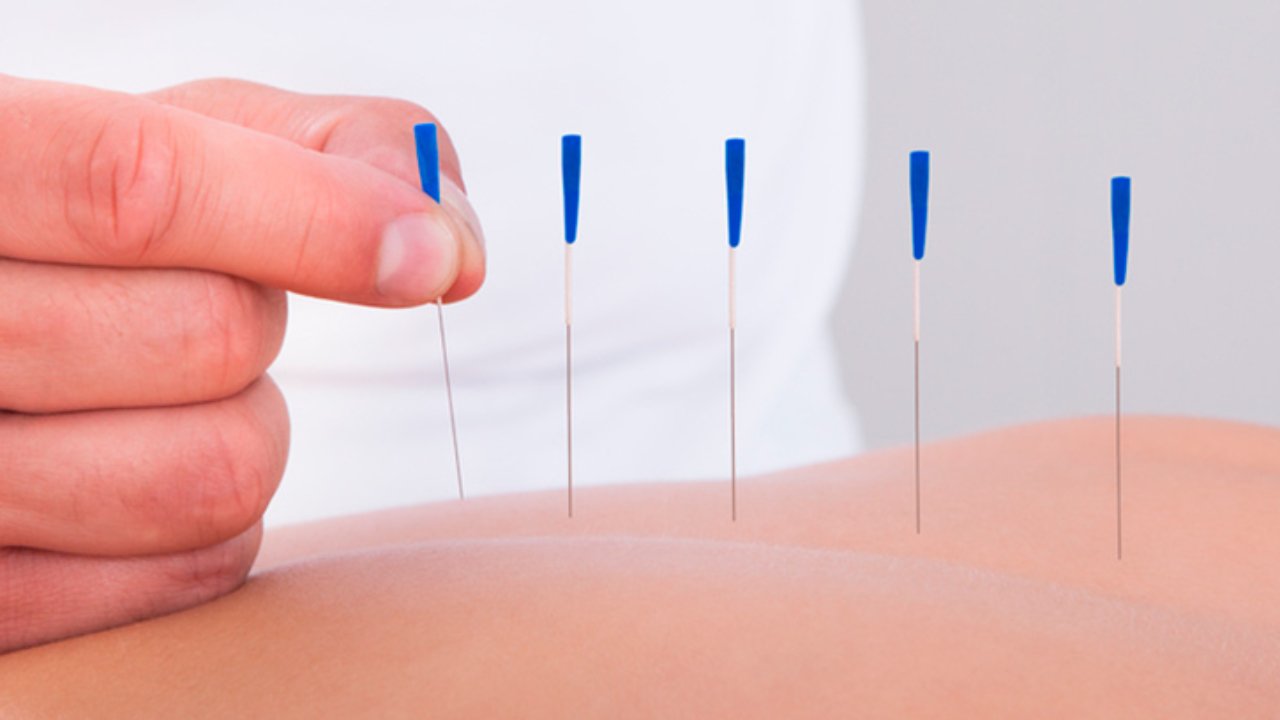 ¿Sabes en qué consiste la acupuntura?