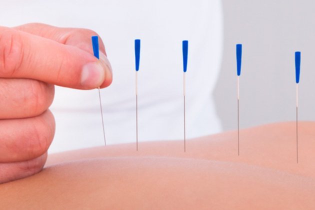 Acupuntura Acupuntura