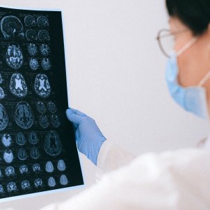 Descubre cómo prevenir el ictus y cuáles son sus síntomas