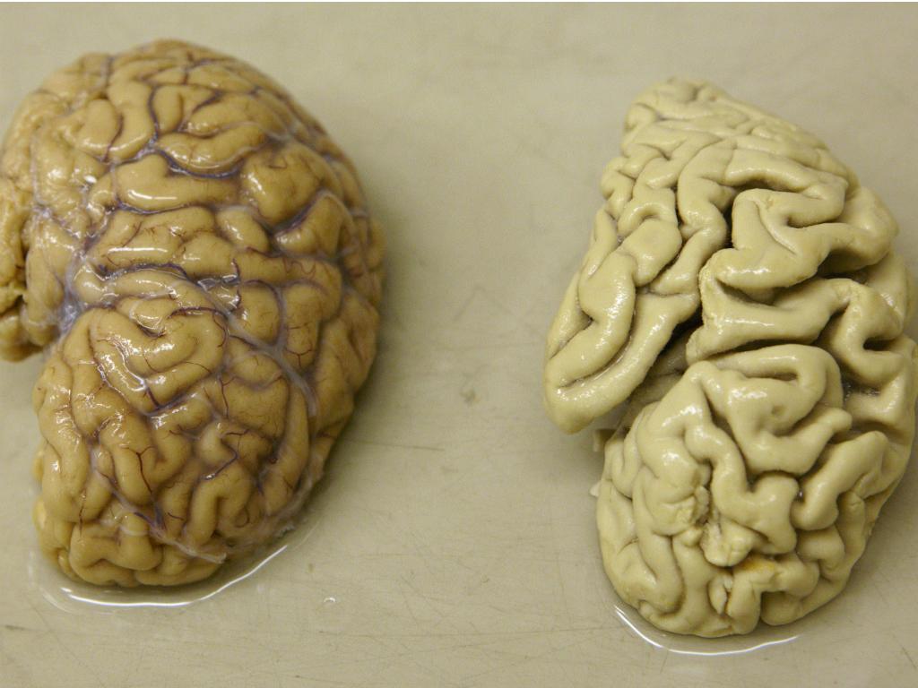 Cervell humà afectat per l’alzheimer / Foto: Research Gate