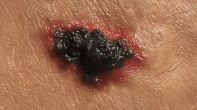 La vacuna contra el melanoma, más cerca