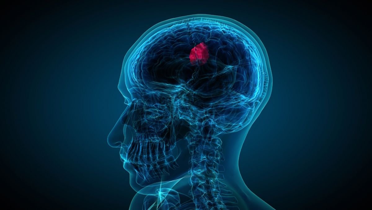 Tot sobre els tumors cerebrals: símptomes, tipus i diagnòstic
