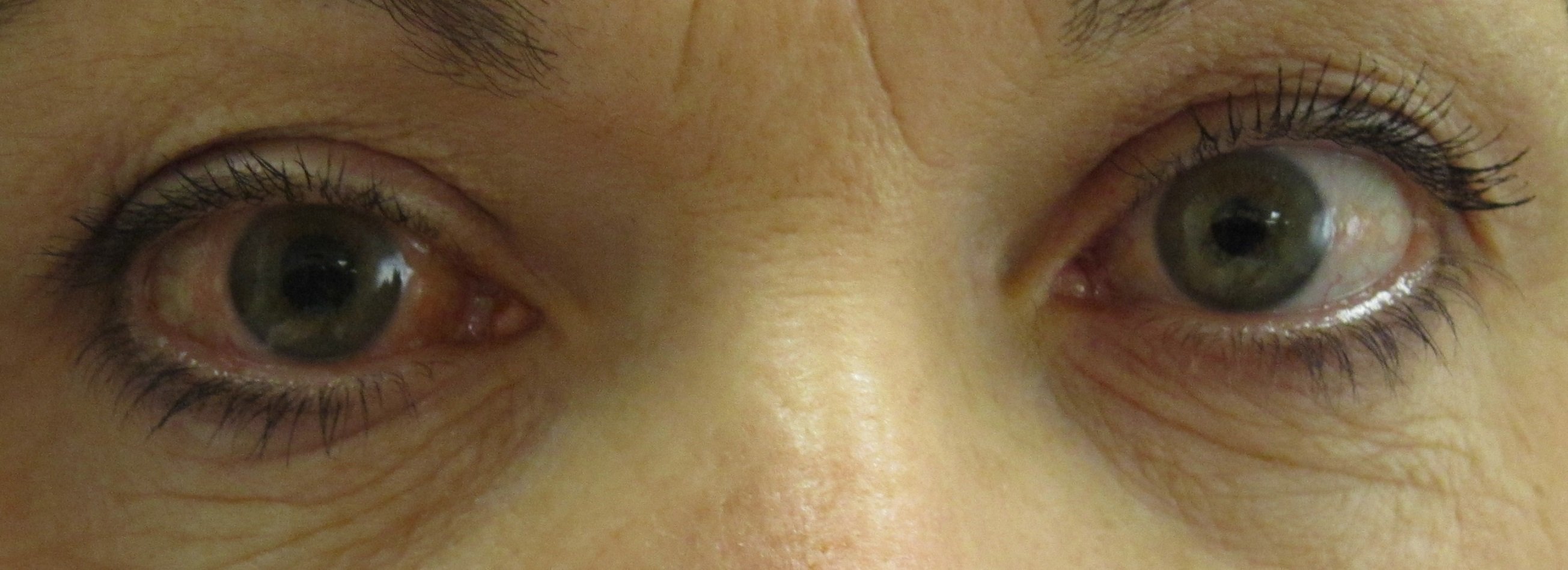 El glaucoma, primera causa de ceguesa a l'Estat