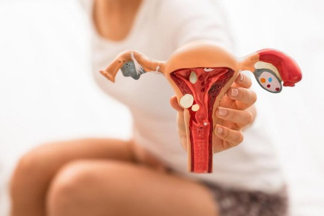 que significa endometriosi ovarica