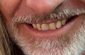 dents felip