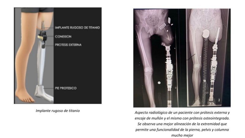 02 Implant rugos titani / Quironsalud