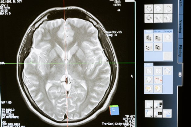 Radiografia cervell / Pexels