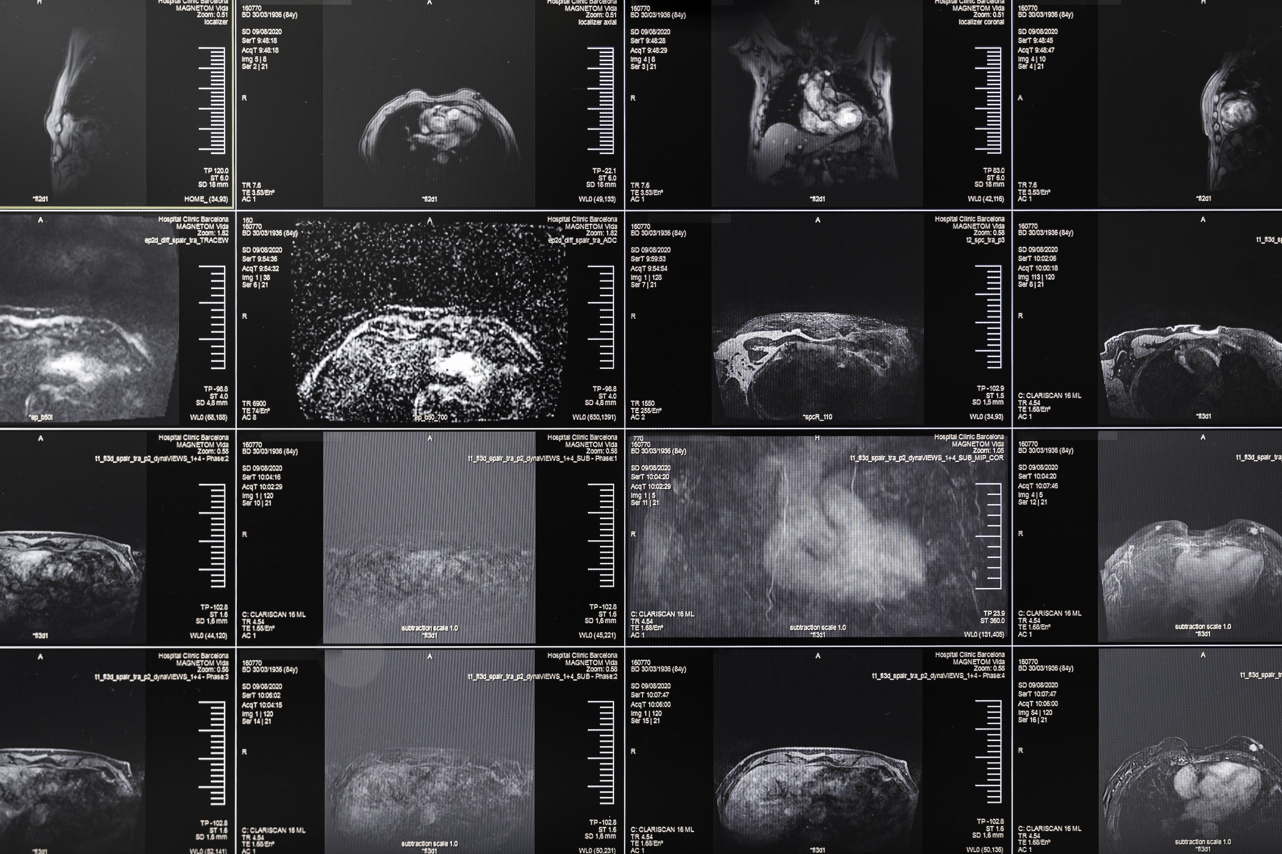 El reportaje de 'ElNacional' "Cáncer de mama a oscuras" gana el Premio Boehringer Ingelheim