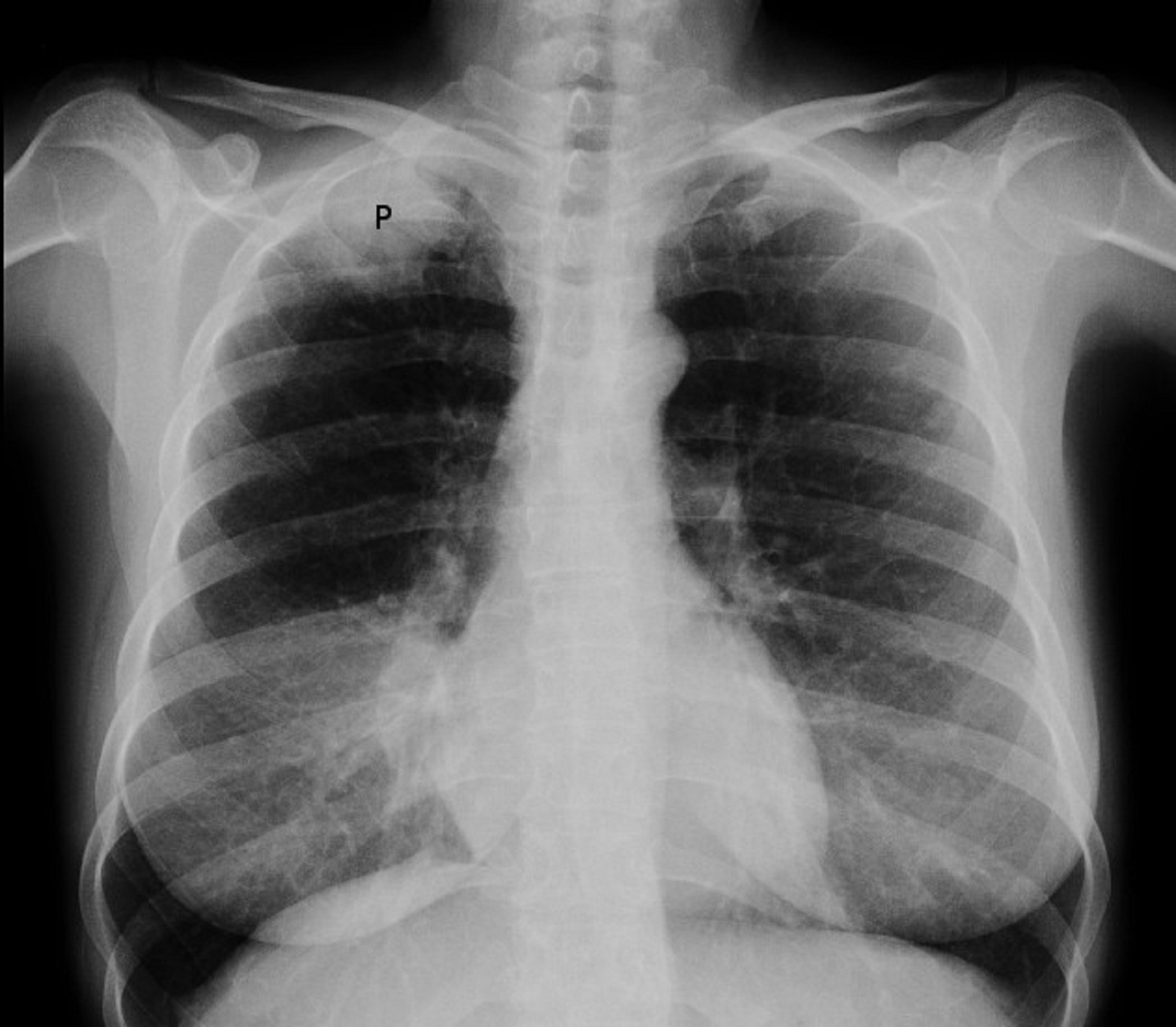 Un tractament contra el càncer de pulmó redueix el risc de mort un 51%