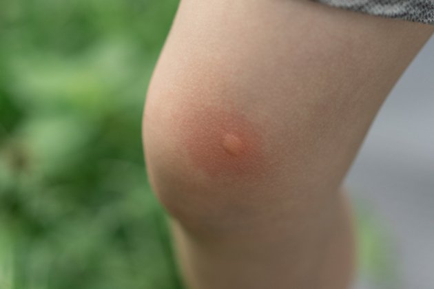 alivio picadura mosquitos 2 alivio picadura mosquitos 2