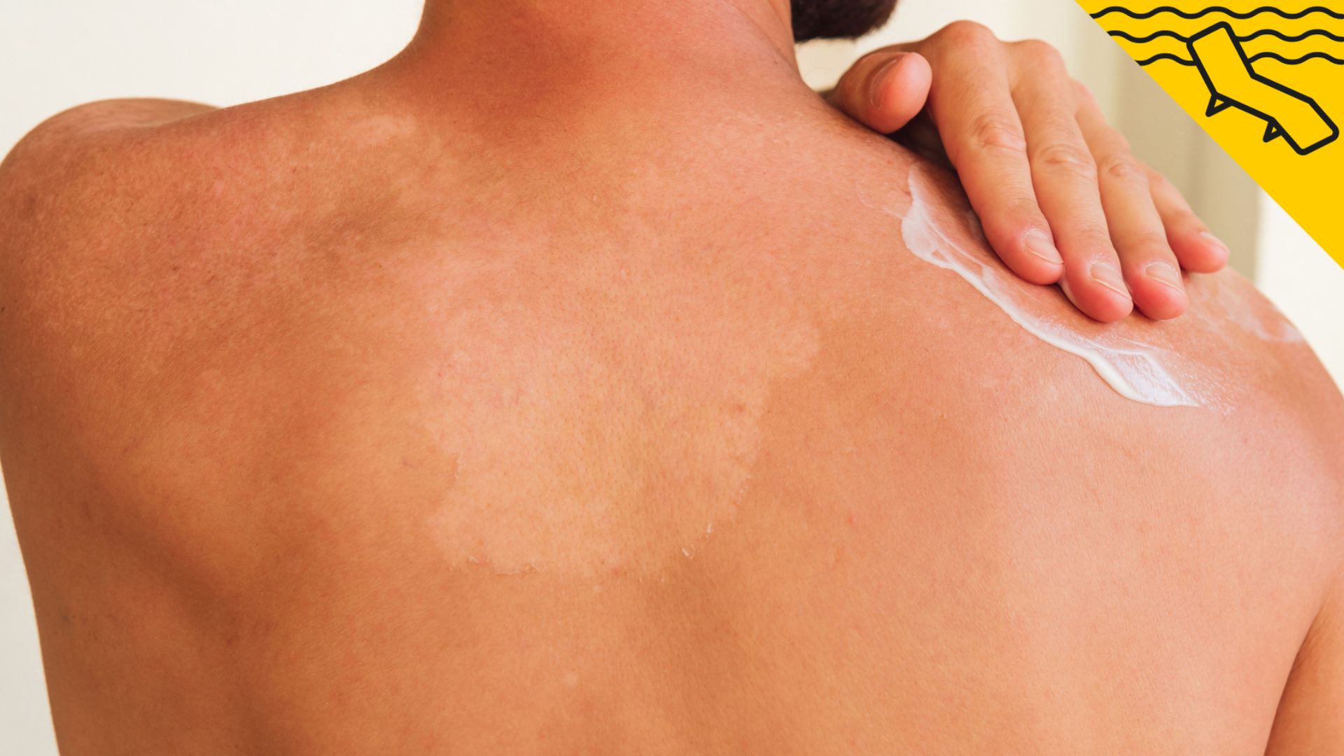 Cómo hacer Aftersun casero y calmar tu piel sin necesidad de cremas comerciales