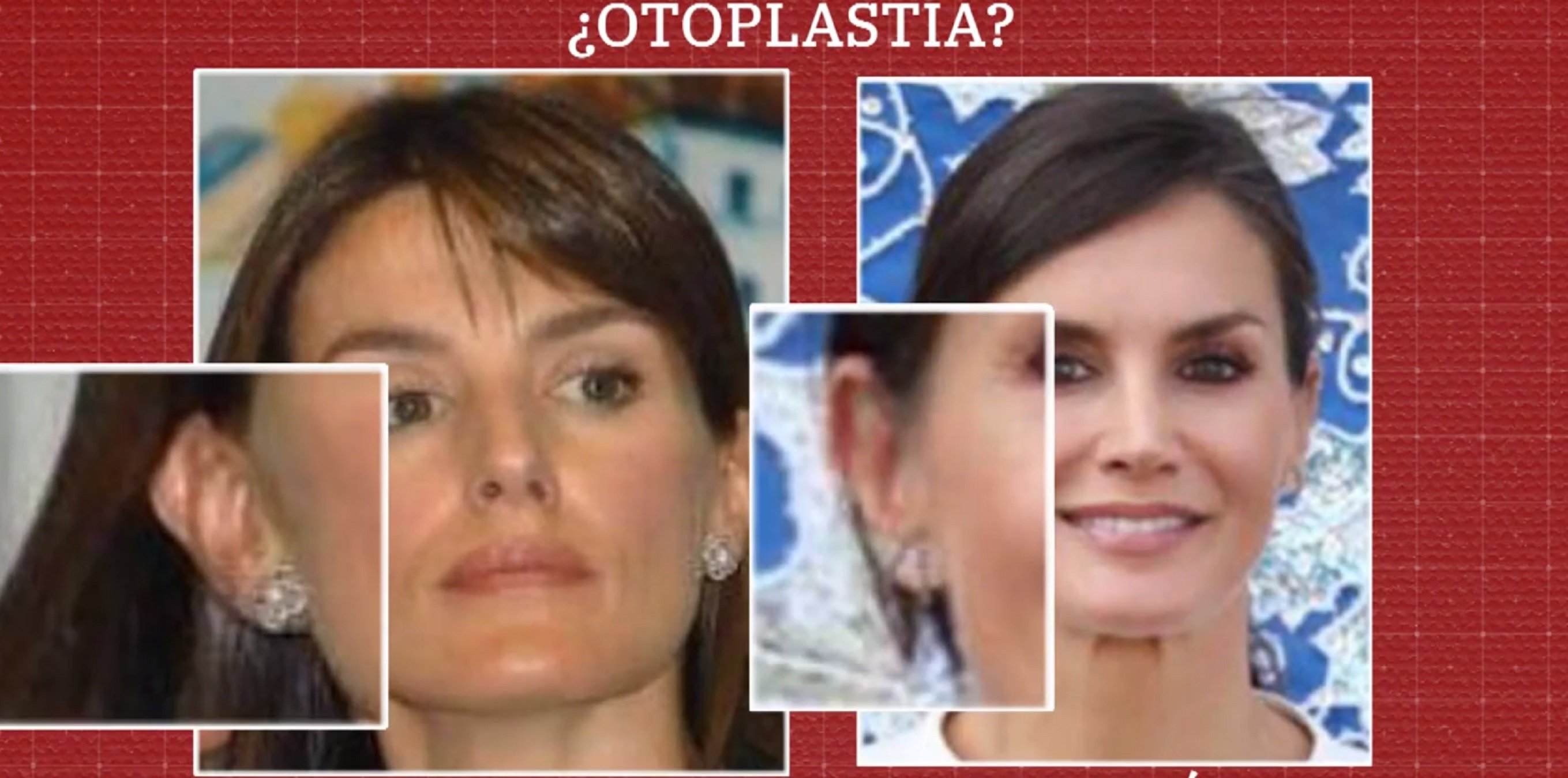 Letizia otoplastia Letizia otoplastia