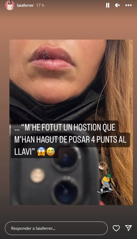 Laia Ferrer labio roto Insta Laia Ferrer labio roto Insta