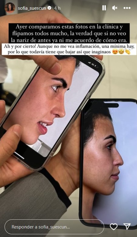 sofia suescun antas despúas nariz Instagram