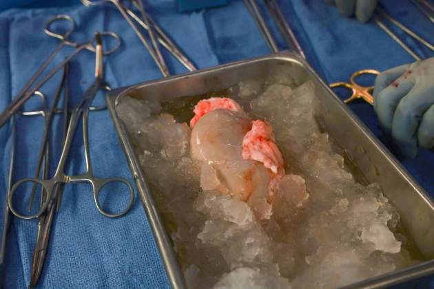 Ronyo porc espera gel per trasplantament Hospital General Massachusetts