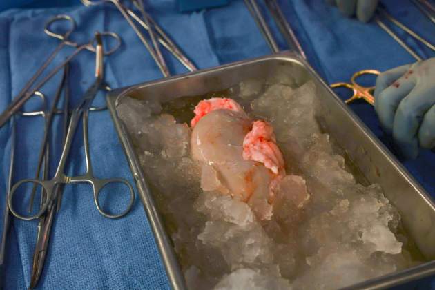 Ronyo porc espera gel per trasplantament Hospital General Massachusetts Ronyo porc espera gel per trasplantament Hospital General Massachusetts