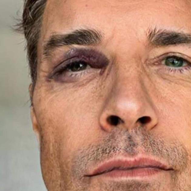 Jesús Vázquez ojo morado / Instagram Jesús Vázquez ojo morado / Instagram