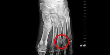 Neuroma de Morton. Foto: Wikipedia Neuroma de Morton. Foto: Wikipedia
