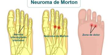 Neuroma de Morton fases Neuroma de Morton fases
