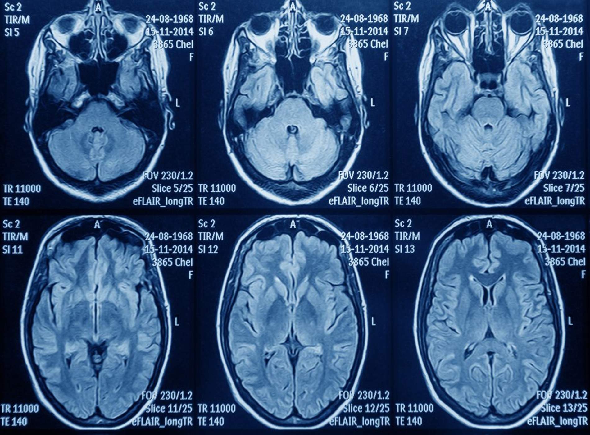 Astuce denuncia que pacientes con glioblastoma "luchan contrarreloj para recibir un tratamiento"