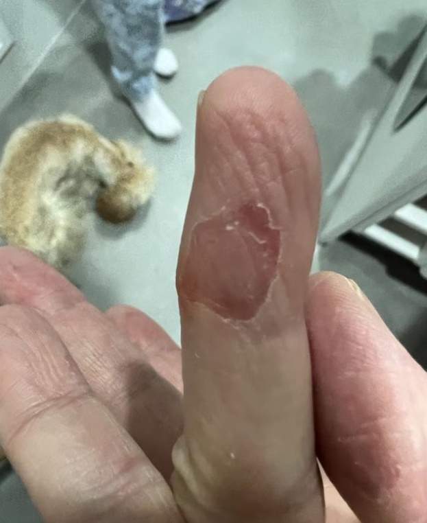 La enfermedad en la piel de Carme Chaparro, en su dedo, Ig La enfermedad en la piel de Carme Chaparro, en su dedo, Ig
